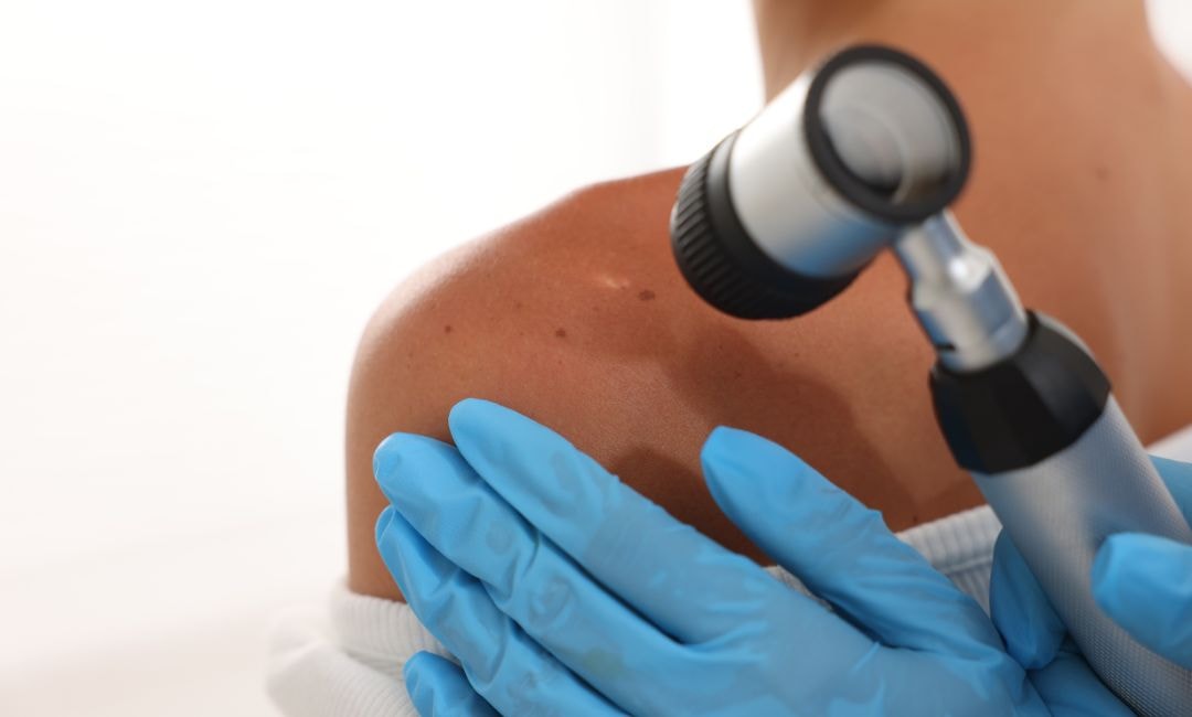 How Early Detection Prevents Stage 4