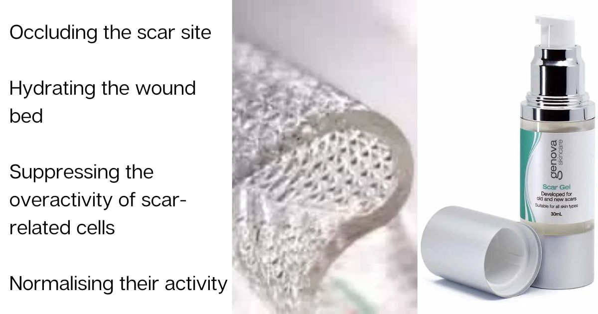 How silicone works for scars