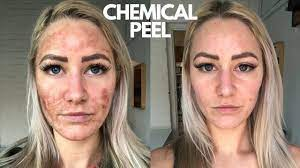 Chemical Peel On Sensitive Skin (NEVER AGAIN!!!) - YouTube