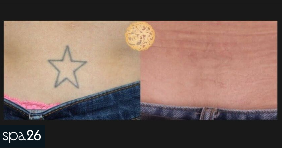 Before and After of Laser Tattoo Removal