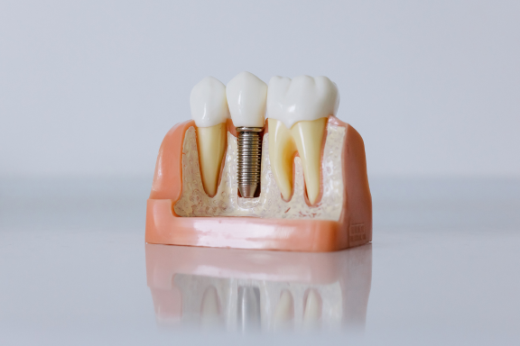 Dental implant model showing components of a titanium metal post, abutment and dental crown 