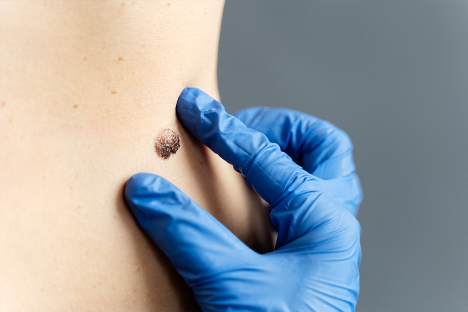 Image of a skilled doctor performing debridement to remove dead or damaged tissue from a wound. Some peptides can assist in this crucial process, promoting a clean wound environment for faster and effective healing.