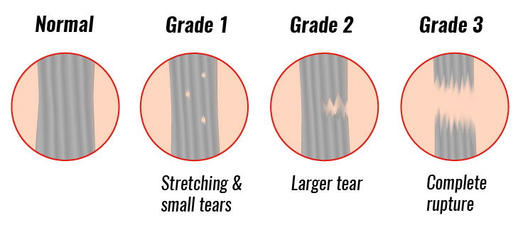 Depiction of the different grades of ligament injuries with grade 1 involving small microscopic tears, grade 2 involving more of the ligament, and grade 3 involving a rupture of the ligament.
