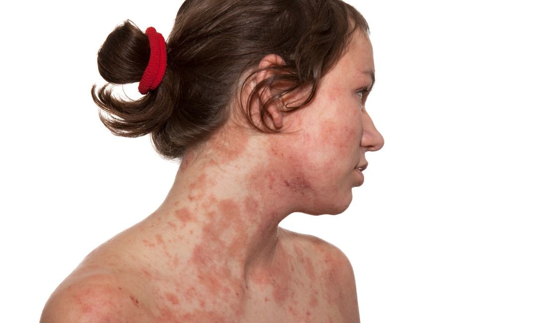 atopic dermatitis