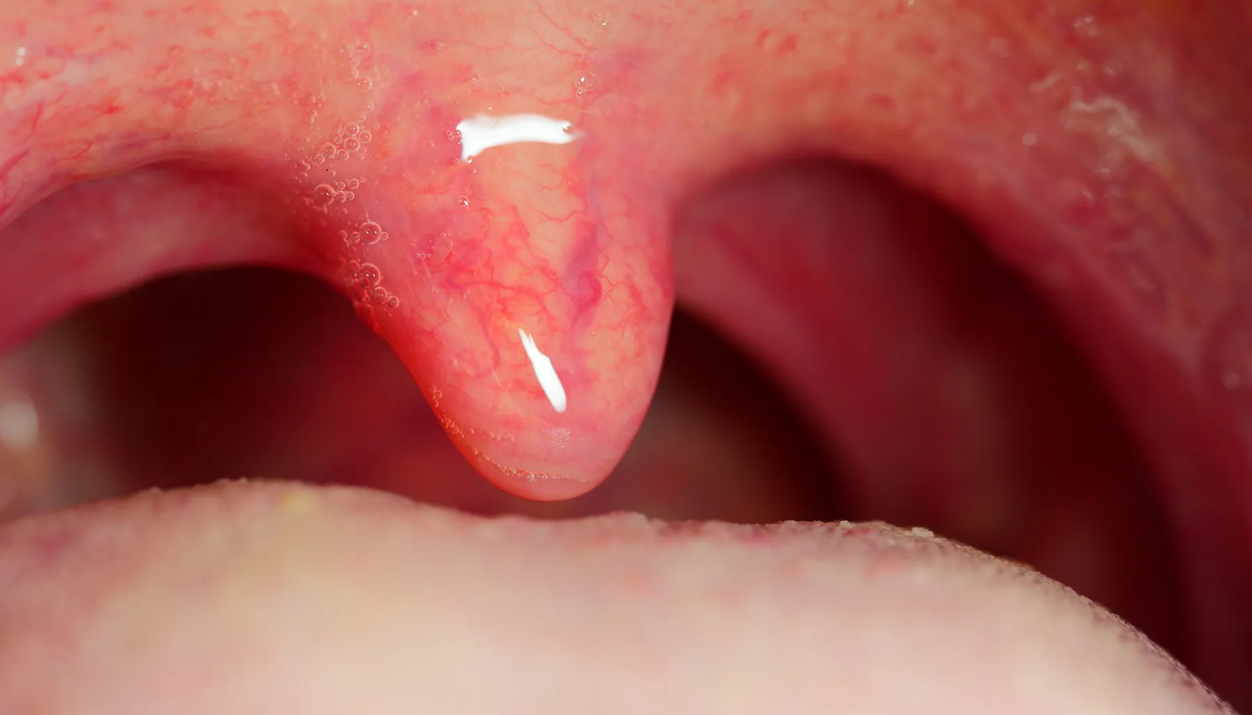 Hovne mandler hals? Dette betyr det for halsen din Hovne mandler hals? Dette betyr det for halsen din