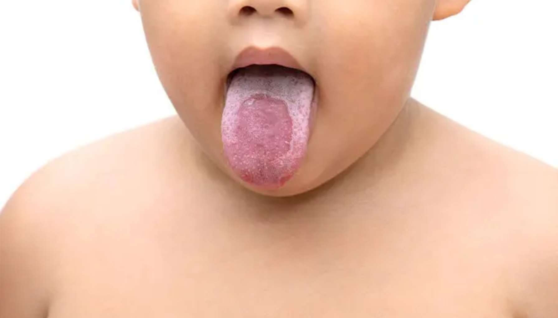 Trøske i Munnen: Ikke Bare for Babyer 15 Barn med lilla eller mørk misfarging på tungen, muligens tegn på infeksjon, blodansamling eller underliggende helseproblem.