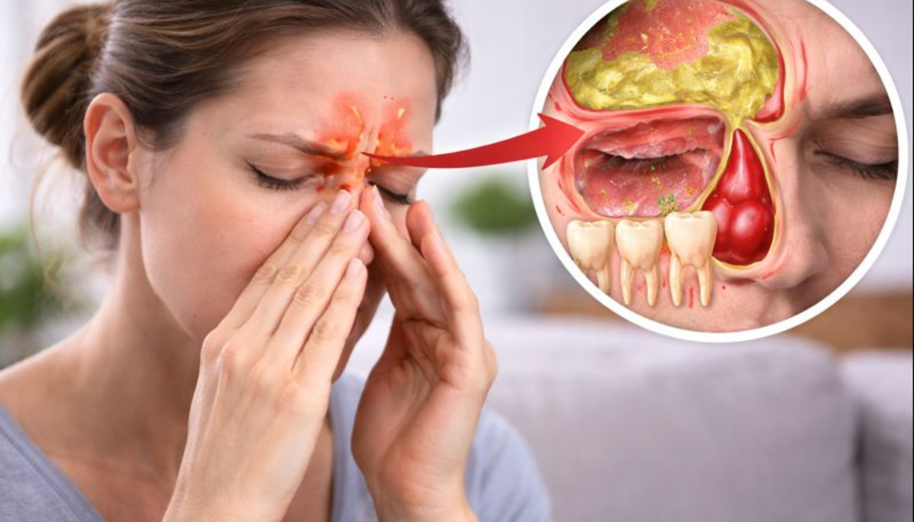 Smerter i hodet når du bøyer deg: tett forbindelse mellom bihuler og tannrøtter 12 Kvinne med bihulesmerter og illustrasjon som viser tanninfeksjon i overkjeven som sprer seg til bihulene.