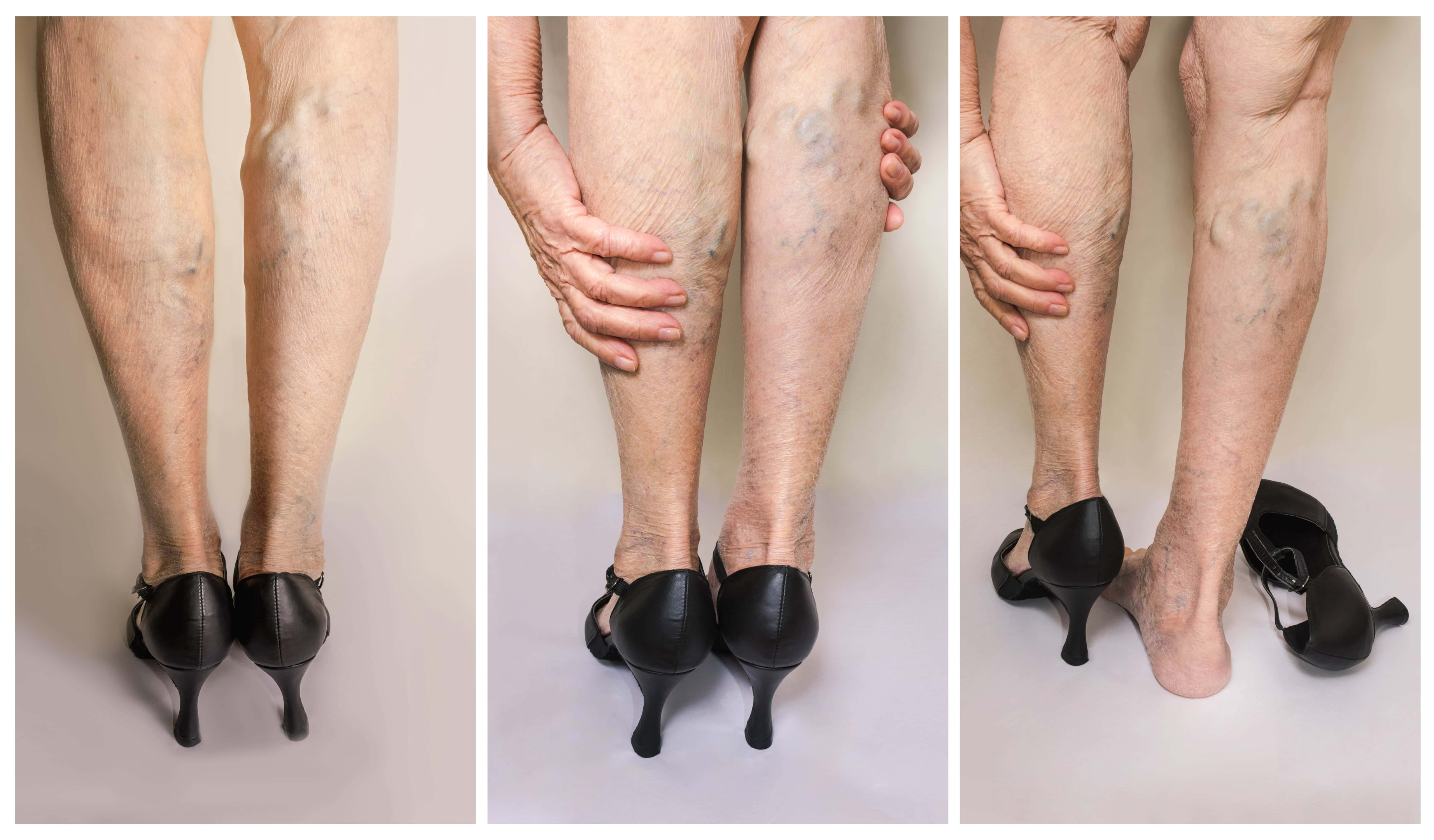 mature woman with painful vaicose veins on her legs
