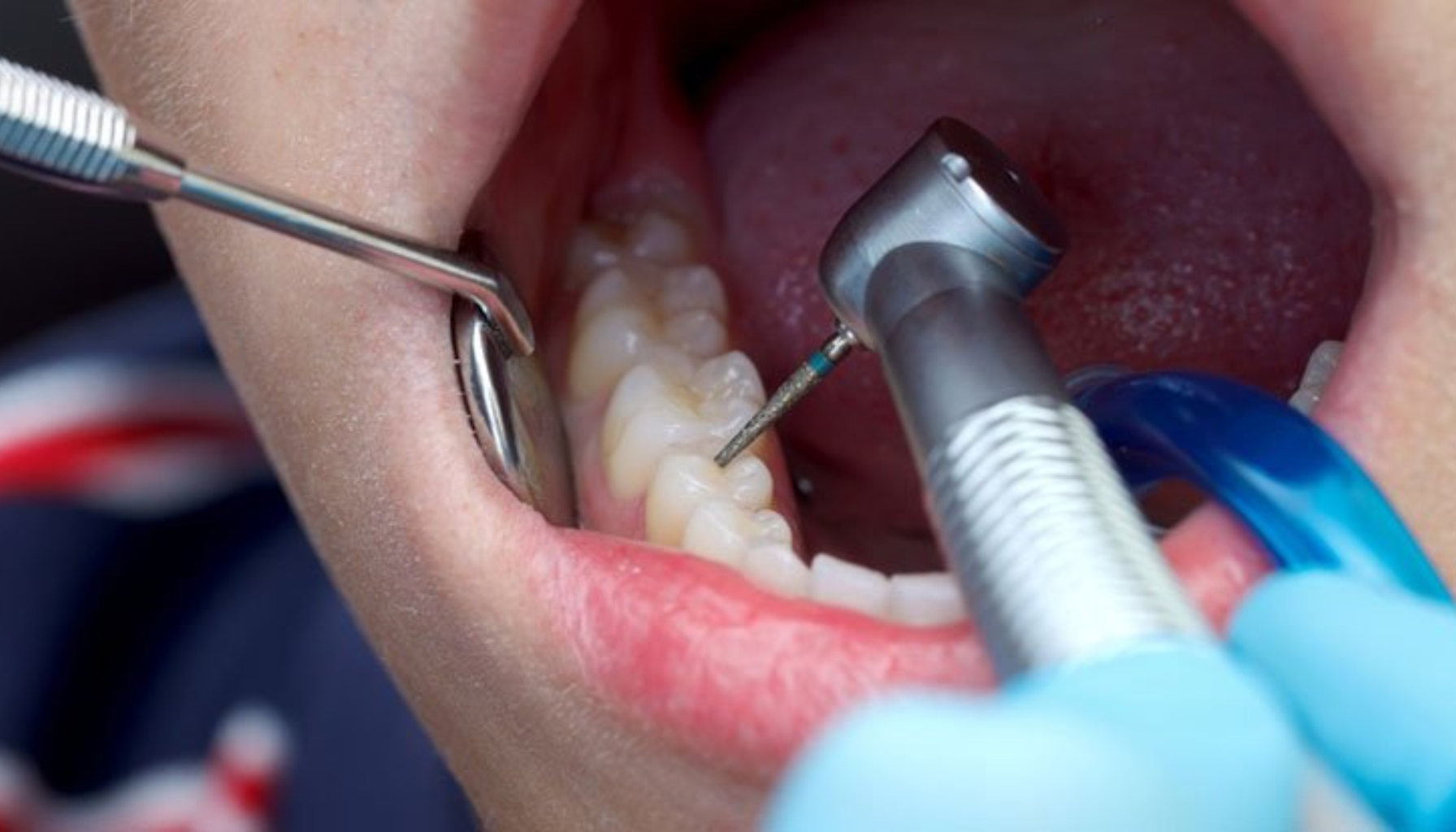 Hvor mye koster det å bore hull? Se pris og alternativer 14 Tannlege bruker bor og speil for å behandle en tann i pasientens åpen munn, med blå hansker og sugeinstrument synlig. hvor mye koster det å borre hull hull i tennene hos tannlegen små hull hull tennene reparere hull tennene dine behandling tannlegen koster mye hos karies kroner tannlege pris tann fylling tannen undersøkelse får prisen priser koste rotfylling mer ofte tannleger helfo dersom tillegg hullet større kompositt røntgen behandlinger bedøvelse tid tenner små behov konsultasjon andre behandlingen kommer samt fyllinger reparere tilbyr ulike munnen refusjon støtte stor betale rundt under gratis dine dyrere oslo våre trenger behandle unngå nødvendig inkludert tannbehandling varierer deler gjelder symptomer nerven litt jeksel røntgenbilder mens behandles pasienter