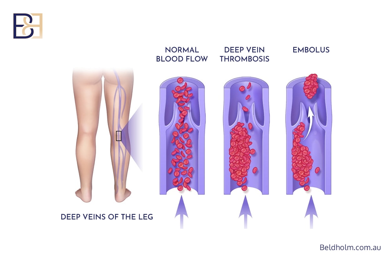 Complications for Upper and Lower Abdominal Lipectomy Post Weight Loss 12 DVT | Dr Bernard Beldholm