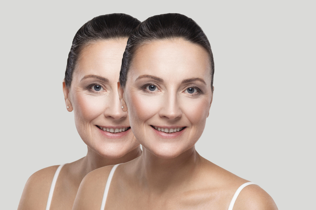 Before and after a cosmetic procedure - not an actual patient - Expect Stunning Results with Dr. Prendiville Serving Fort Myers, Naples, and Coral Springs