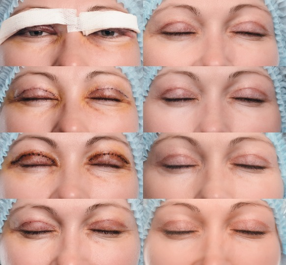 A series of upper blepharoplasty recovery photos day by day showcasing the healing process after the surgery.