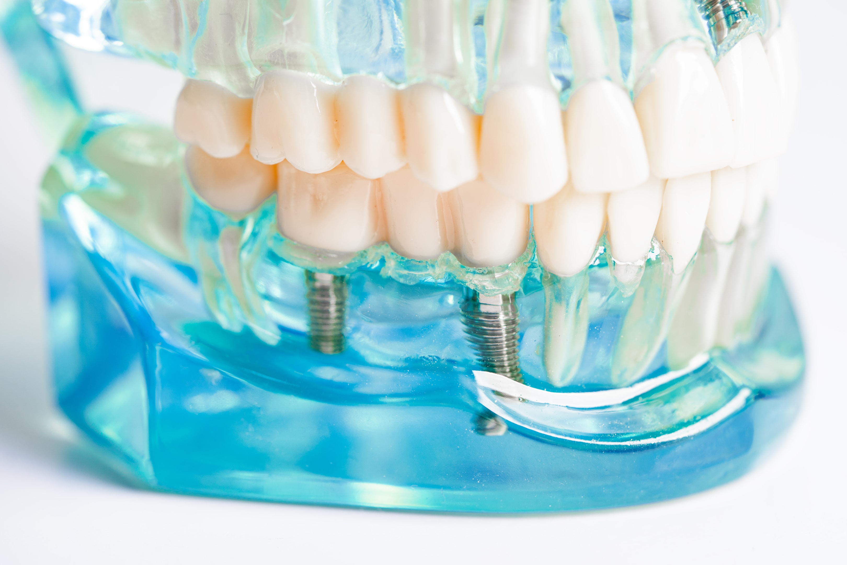 dental model showing dental implants