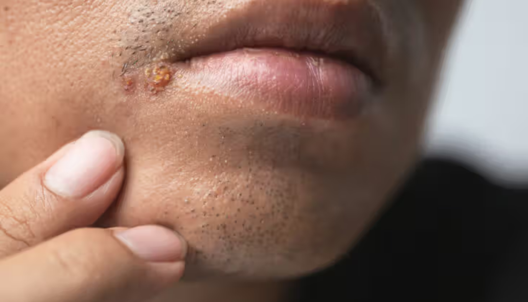 Herpes i munnen den vanlige men ofte misforståtte infeksjonen 5 Mann peker på smertefullt munnsår ved munnviken, med gul skorpe som tyder på aktiv herpesinfeksjon.