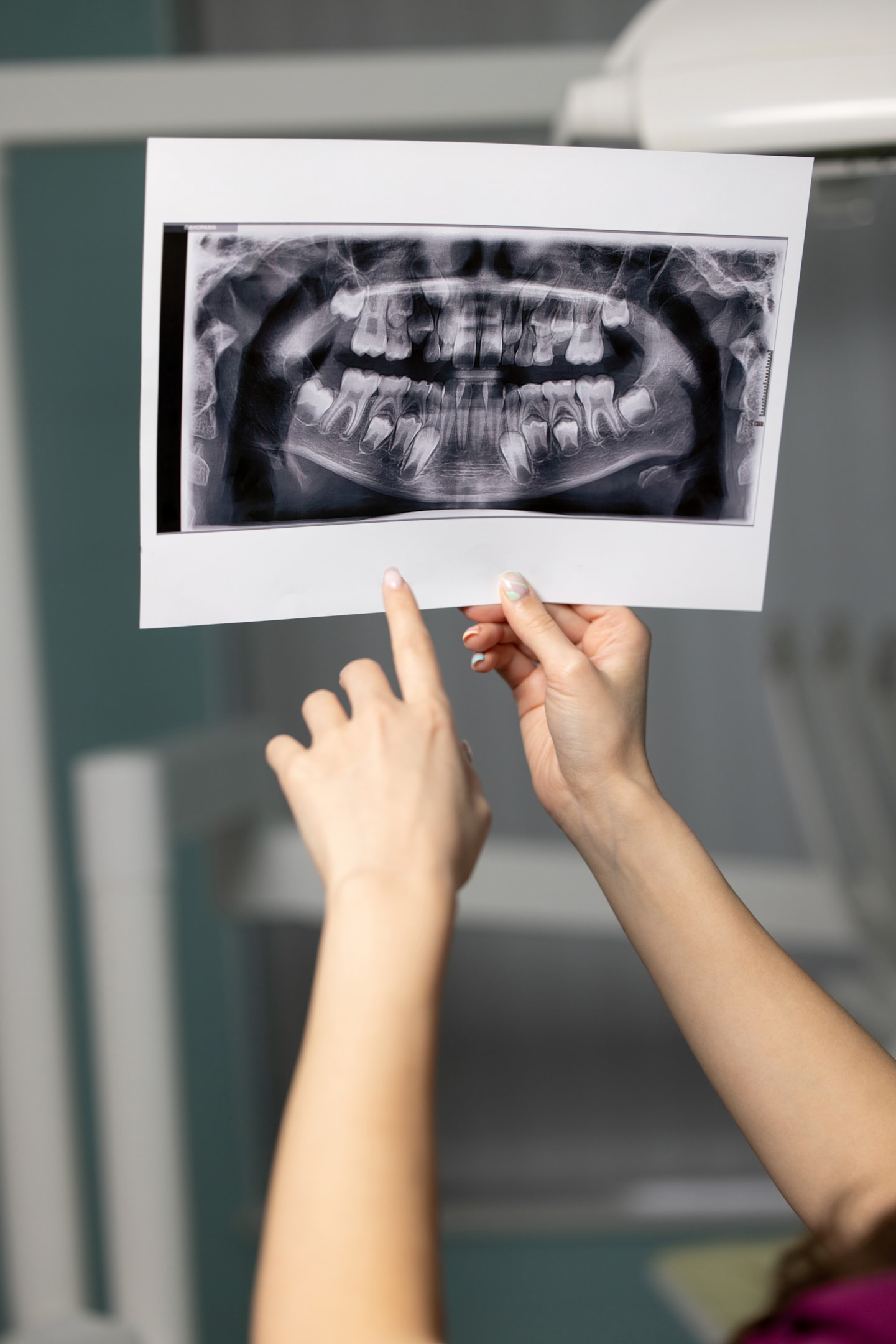 X-ray showing impacted wisdom teeth