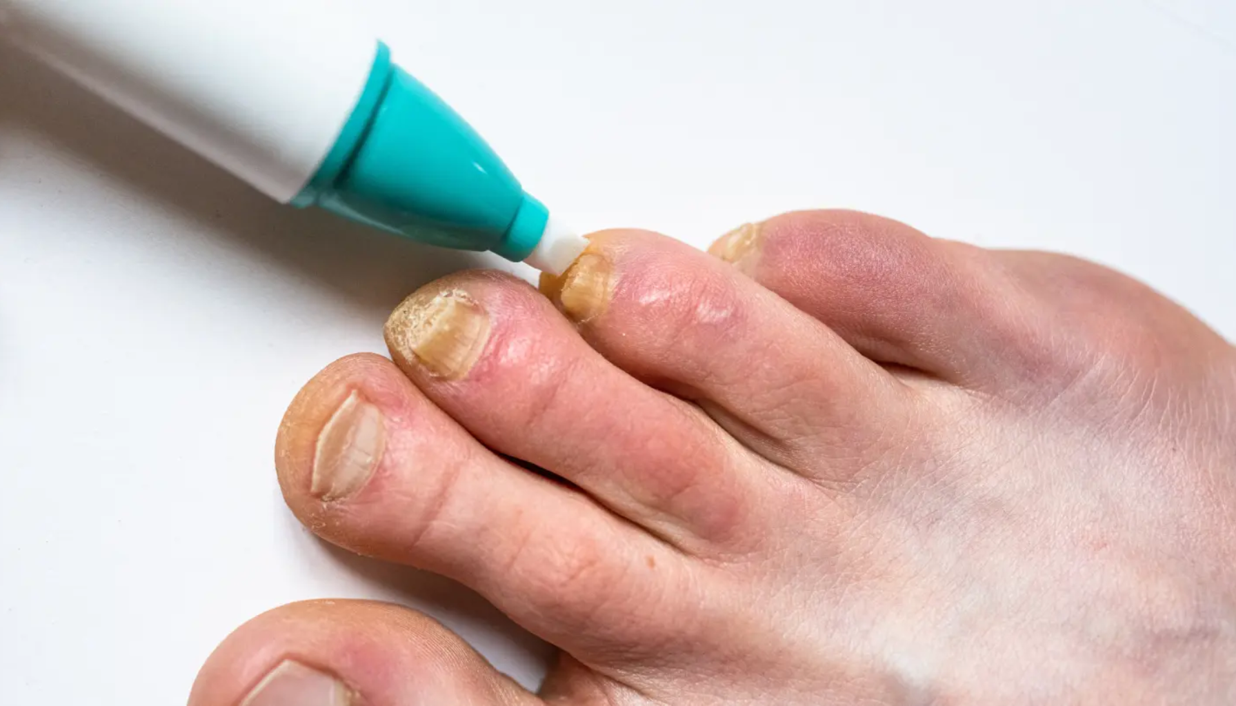 Candida: Den skjulte soppen i kroppen din 18 Behandling av neglesopp på tånegl med medisinsk penn."