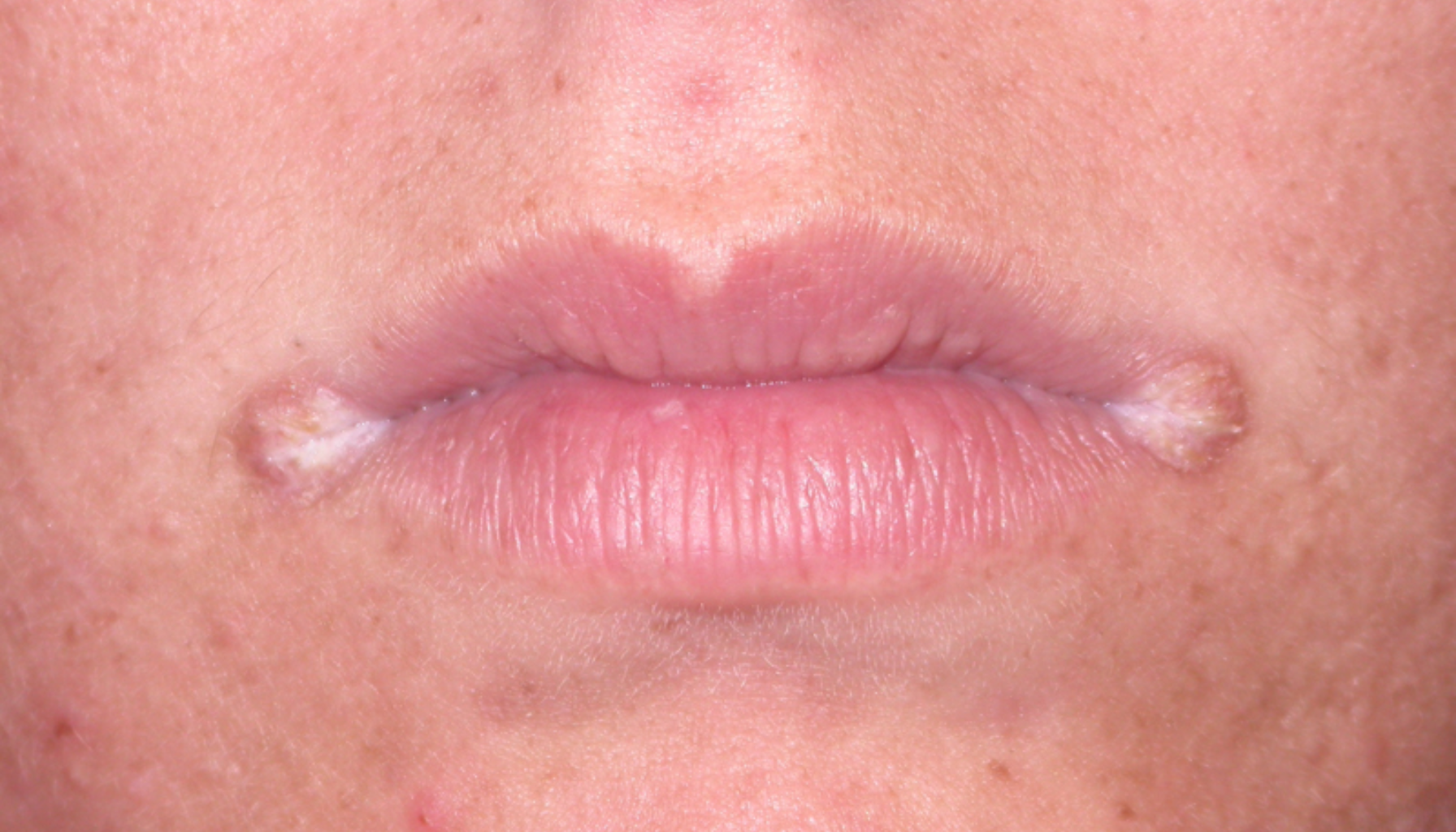 Angulær cheilitt: Sår i munnviken du ikke bør ignorere 18 "Sprekker og betennelse i begge munnviker med hvitaktig belegg som tyder på infeksjon."