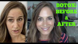 BOTOX: Best Before & After Video! - YouTube