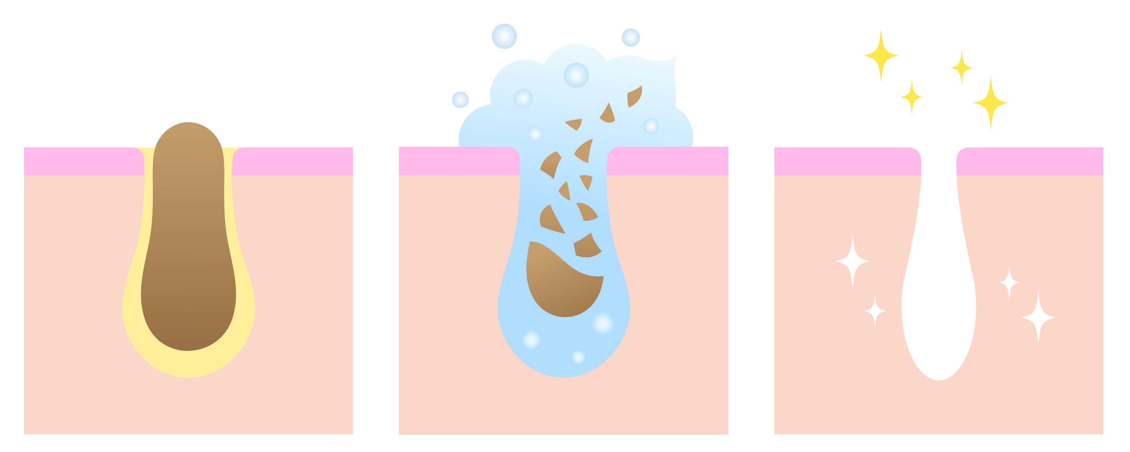 Diagram of dead skin cells