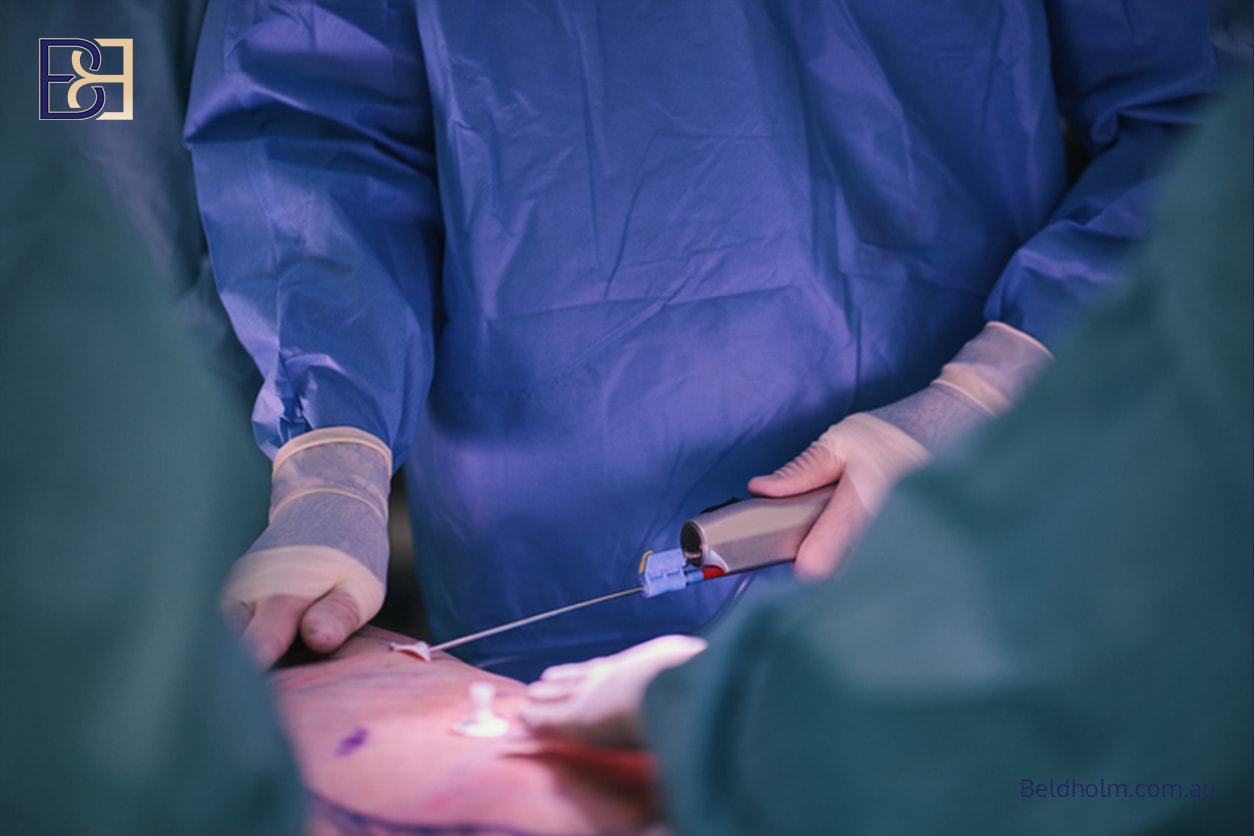 VASER liposuction (suction-assisted lipectomy)