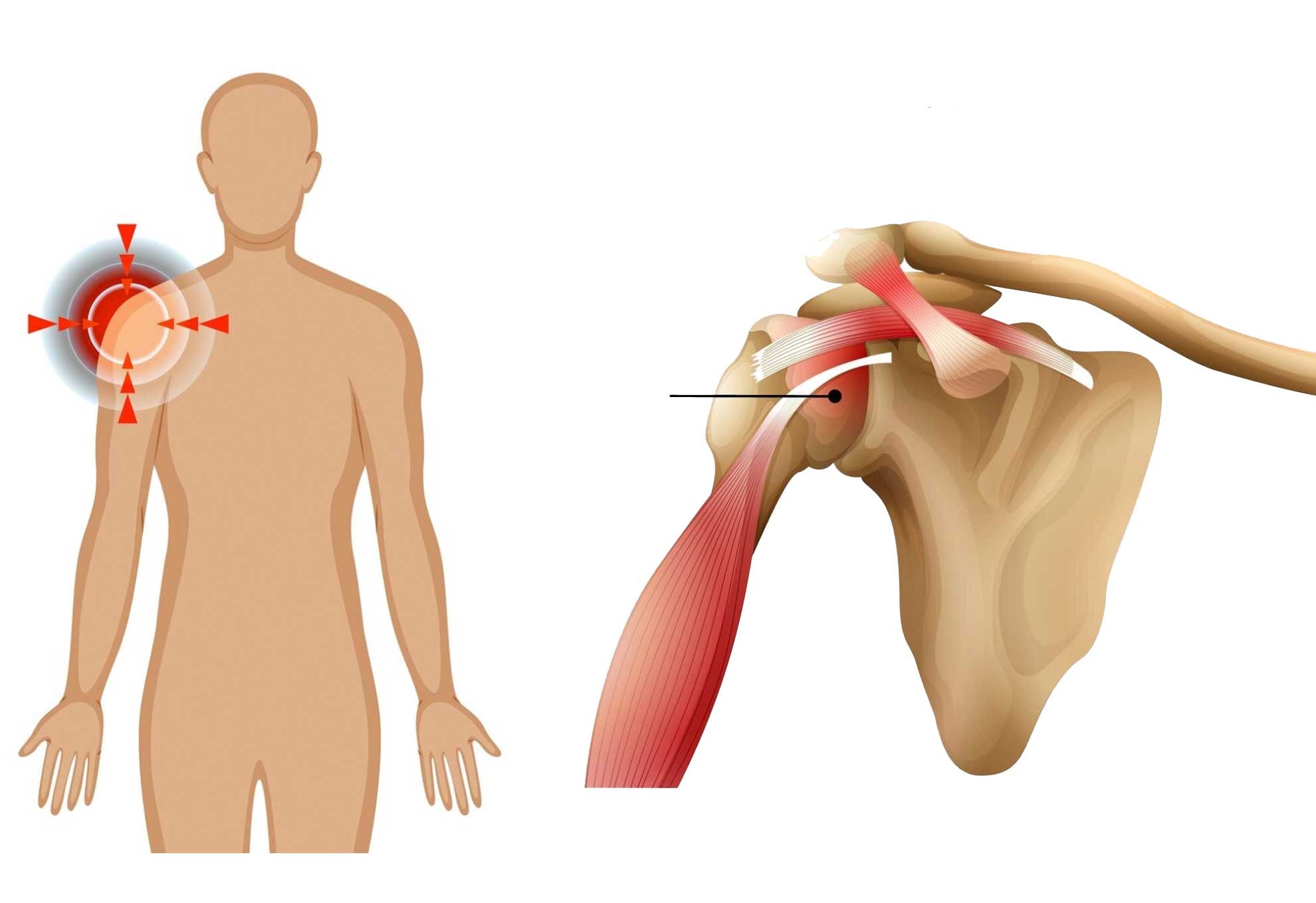 Zamrożony bark – ograniczenie ruchomości barku