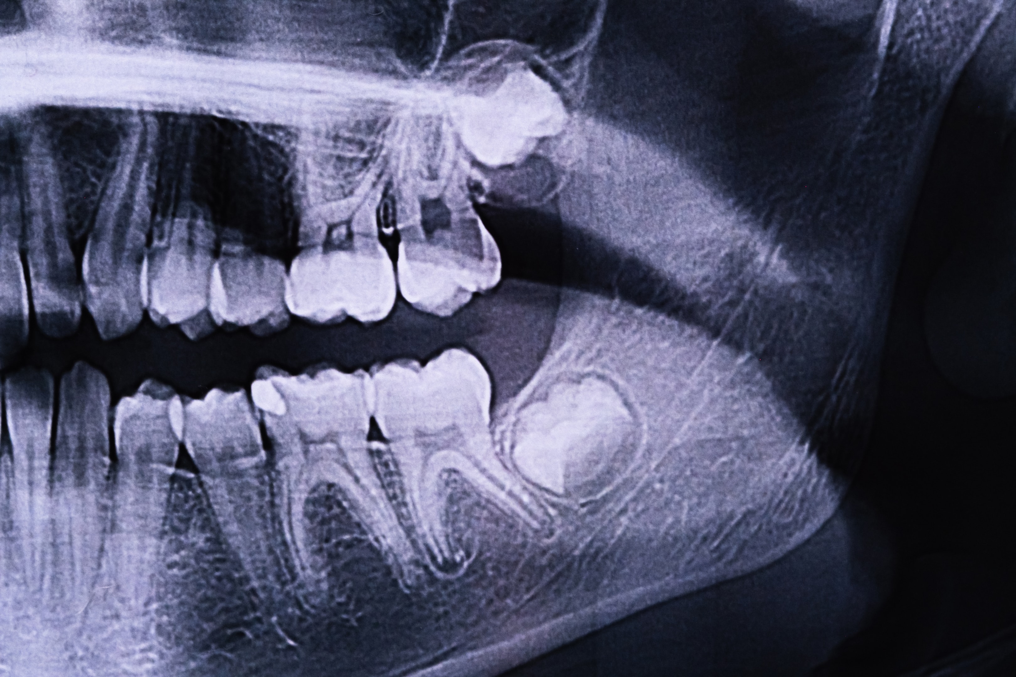 An image of a partially erupted wisdom teeth under X-Ray