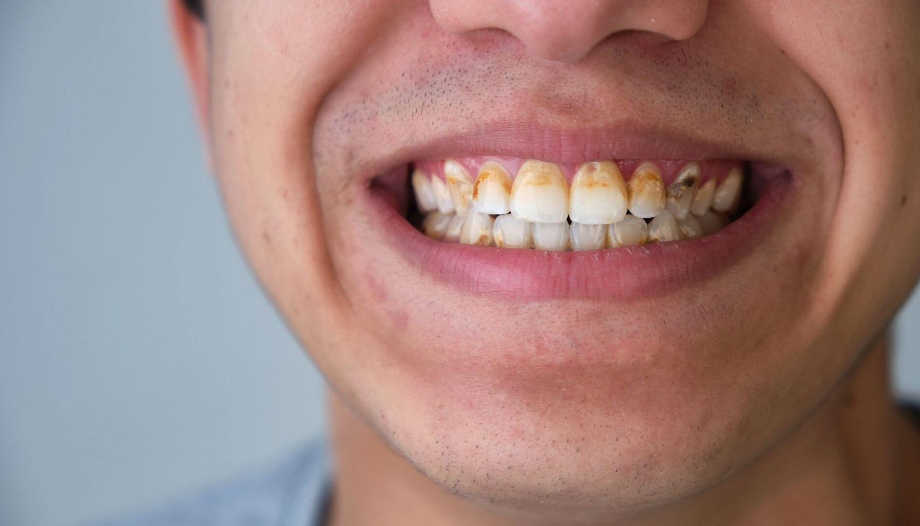 Nærbilde av smil med kraftige misfarginger og tannstein på fortennene, indikerer dårlig munnhygiene og behov for profesjonell tannbehandling.