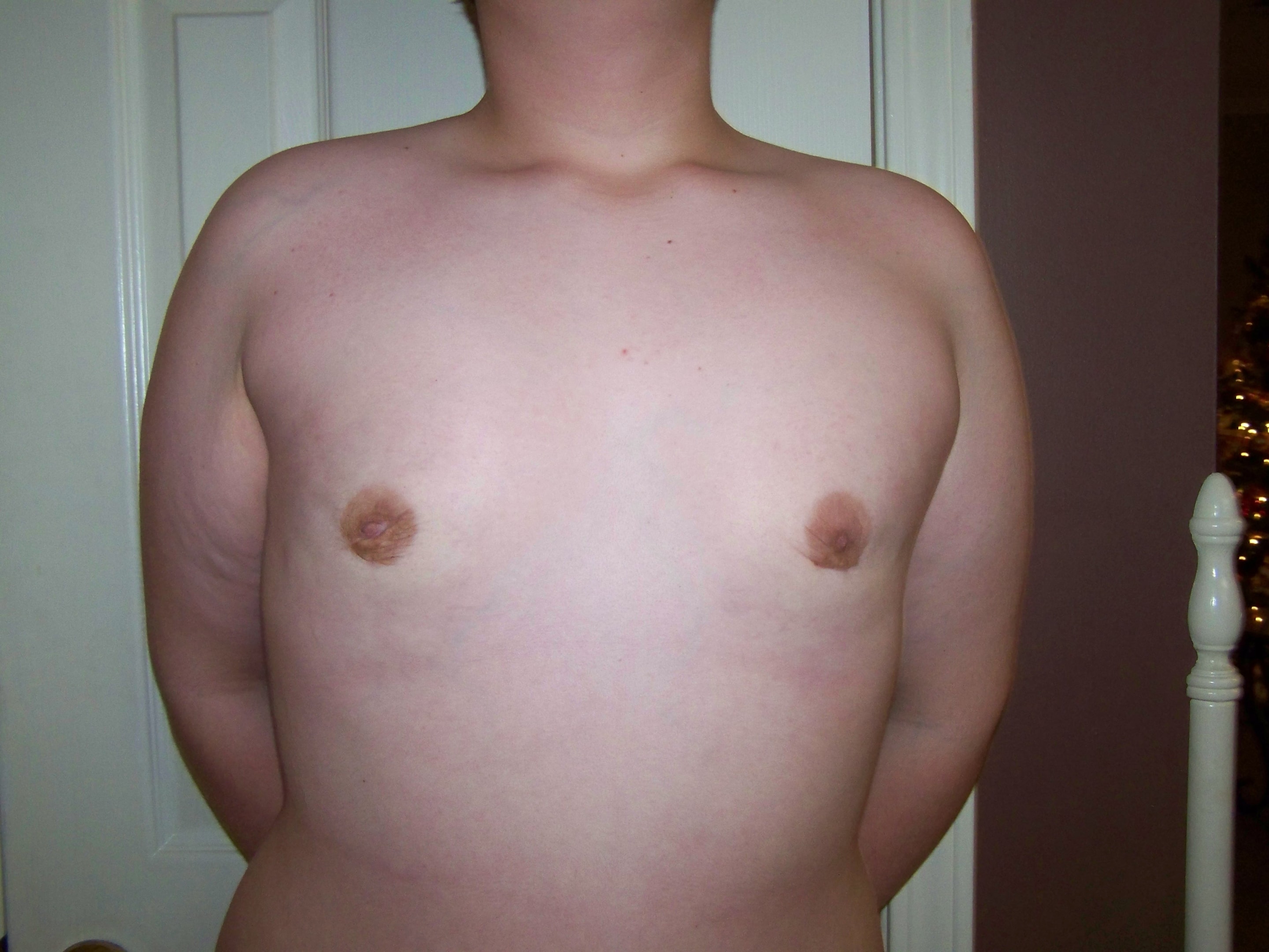 Same patient after 1 stage breast gland exciscion with liposuction. Note the significant skin contraction.