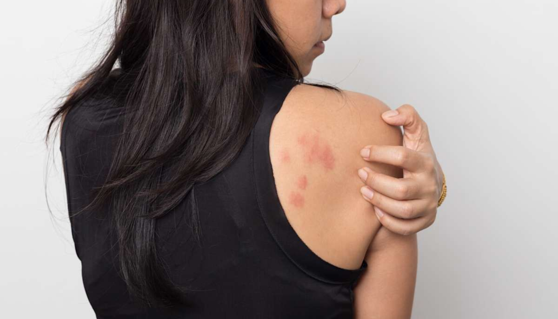 Bildet viser en kvinne med røde utslett på skulderen som hun klør på, noe som kan tyde på allergisk reaksjon eller hudirritasjon.