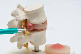 543 Herniated Disc Stock Photos - Free & Royalty-Free Stock Photos from Dreamstime