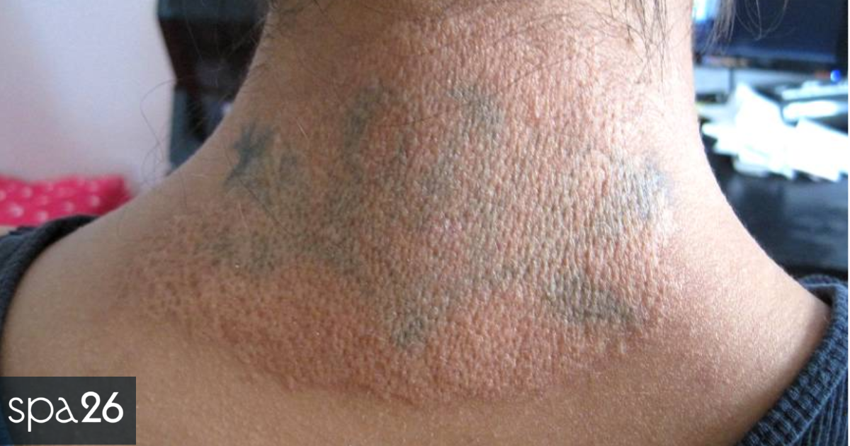 Laser Tattoo Removal Aftercare - Normal and Warning Signs
