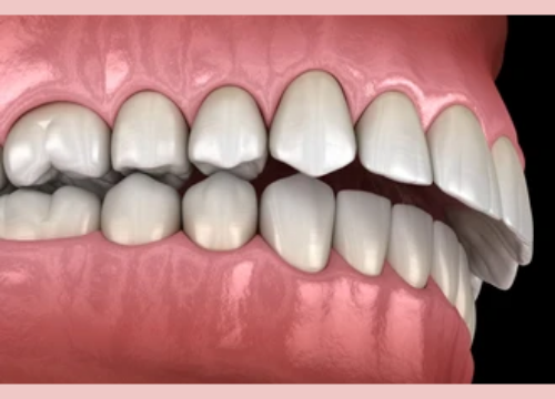 Overbite: Here's Everything You Need To Know