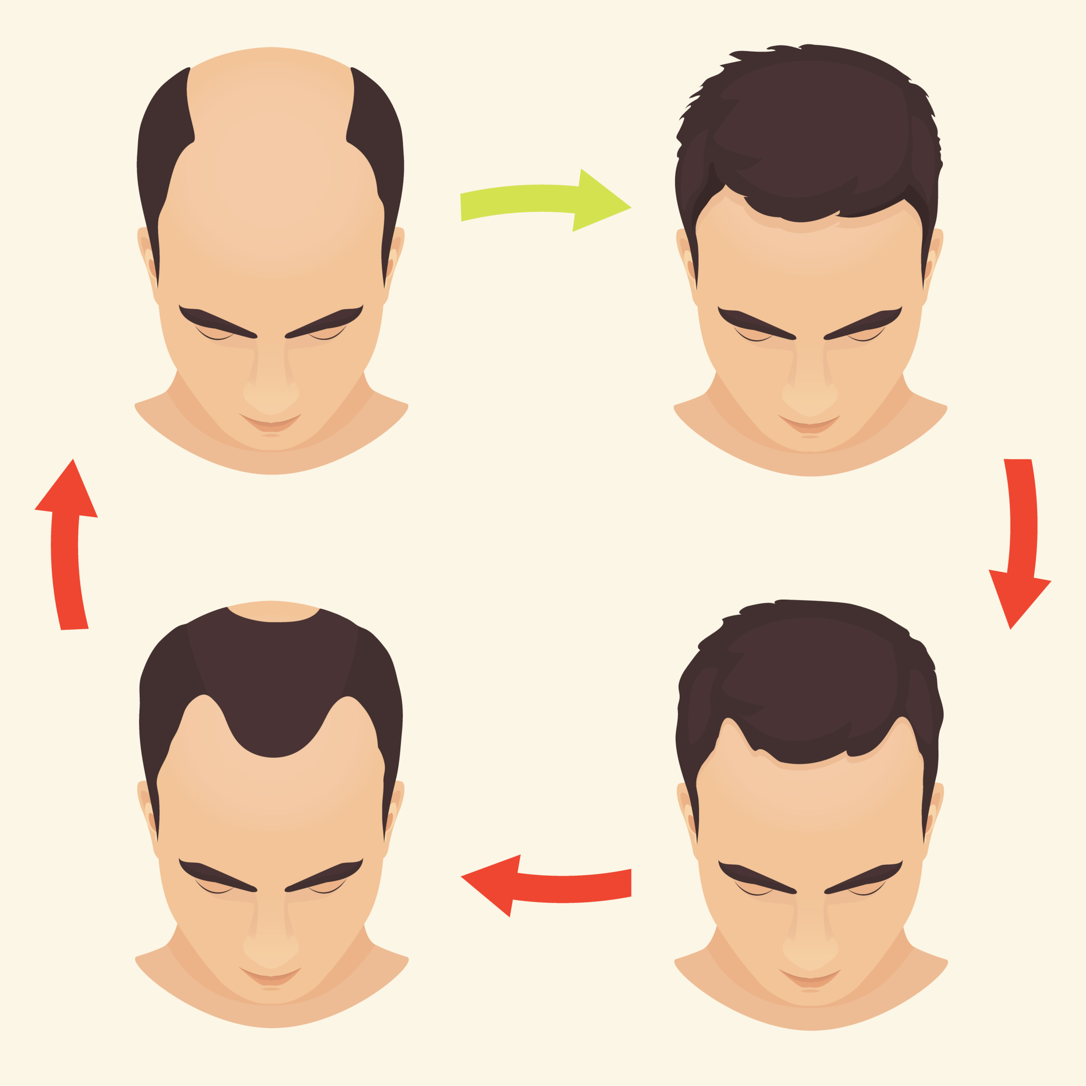 An illustrated diagram showing the progressive stages of male pattern baldness: full head of hair; balding at the temples; a receding hairline; thinning at the crown and then eventually complete hair loss along the top of the scalp. 