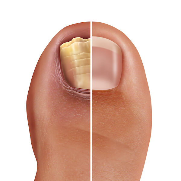 infected nail, toenail fungal infection, fungal nail infection