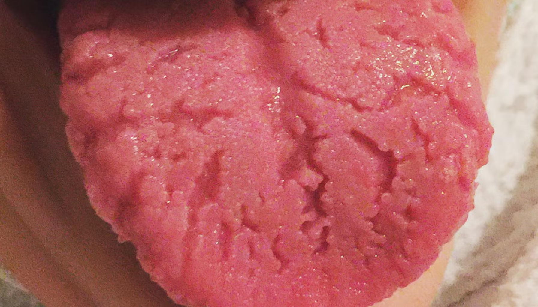 Sprekker i tungen: Vanlig, men verdt å følge med på 11 Tunge med dype sprekker og ujevn overflate som viser tydelig irritasjon og mulig betennelse ved nærbilde. sprekker i tungen geografisk tunge sprekker på tungen røde flekker tungen hvite eller røde tunge hvitt belegg munnen sprekker mer soppinfeksjon hos behandling andre bør viktig sår symptomer tunga belegg tegn flekker årsaker ofte vanligvis munnhygiene dårlig hvite god infeksjon munnhulen ser lege får skyldes mat gjør forhindre gjøre imidlertid enkelte gir symptomene bakterier tilfeller infeksjoner svie personer tilstand les bort områder person riktig del munn tilstander årsaken utseende diabetes finnes små ulike smerter risikoen ganger følelse mangel vanlig stress lite artikkelen dekket overflate svært tørr dag gang alvorlig igjen