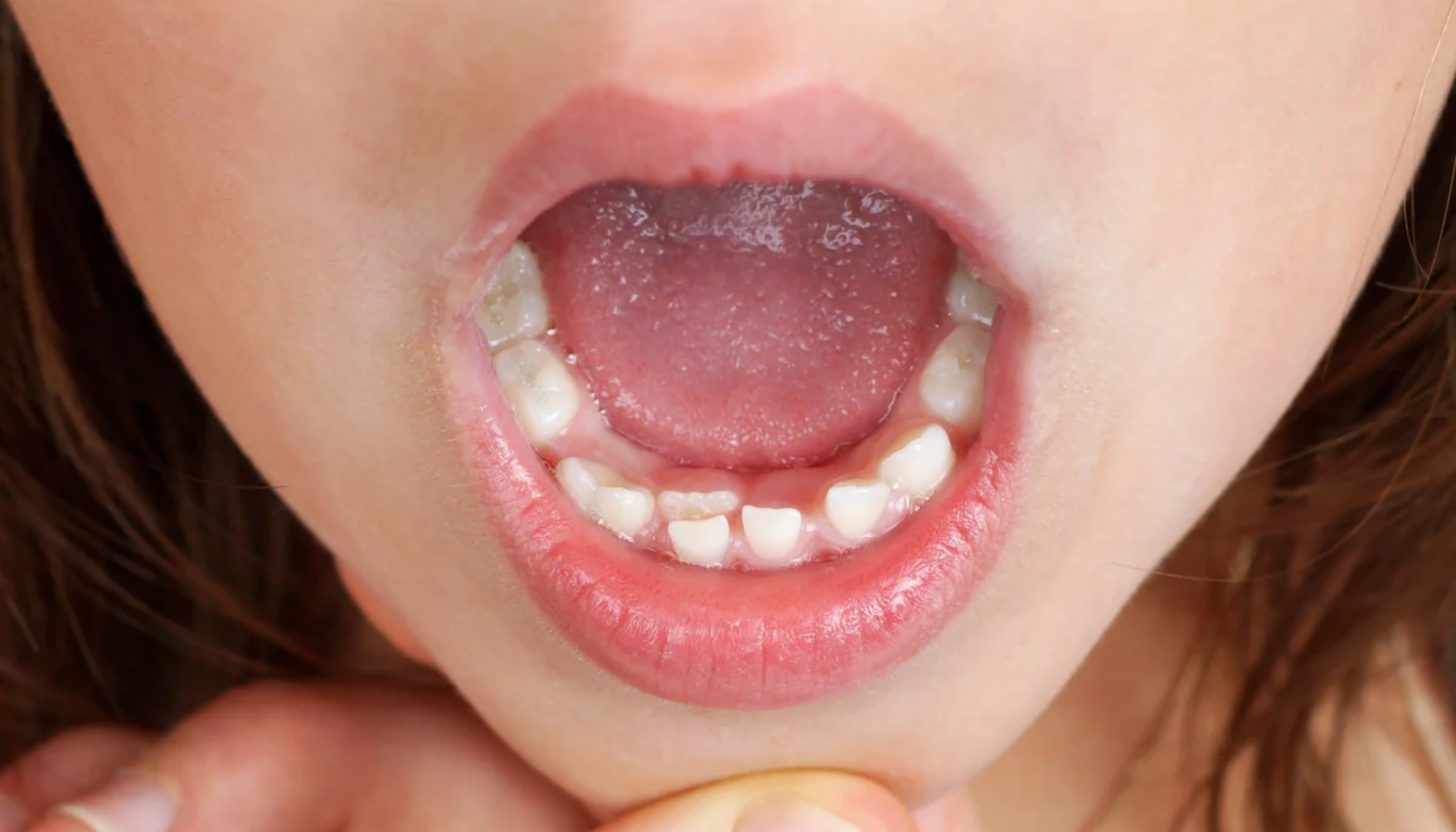 Bytte tenner – Fra melketenner til permanente tenner