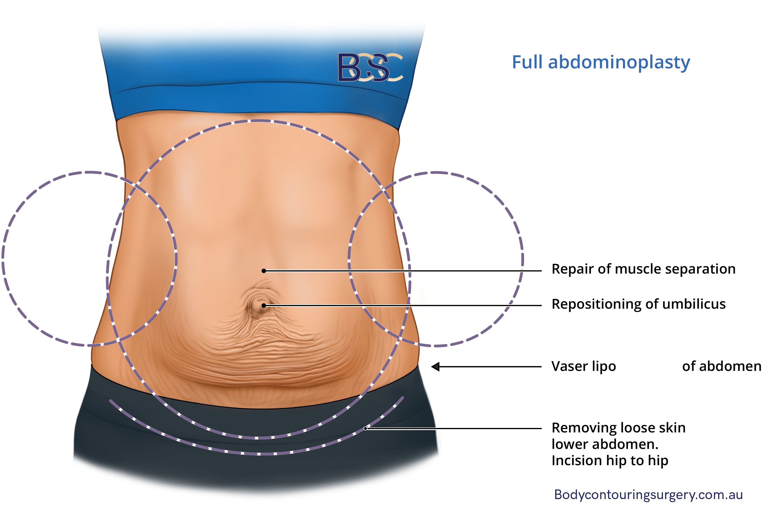 Full abdominoplasty or traditional abdominoplasty
