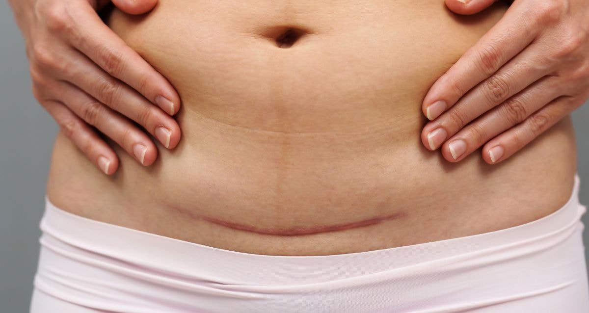 Scar after healthy c-section surrogacy pregnancies