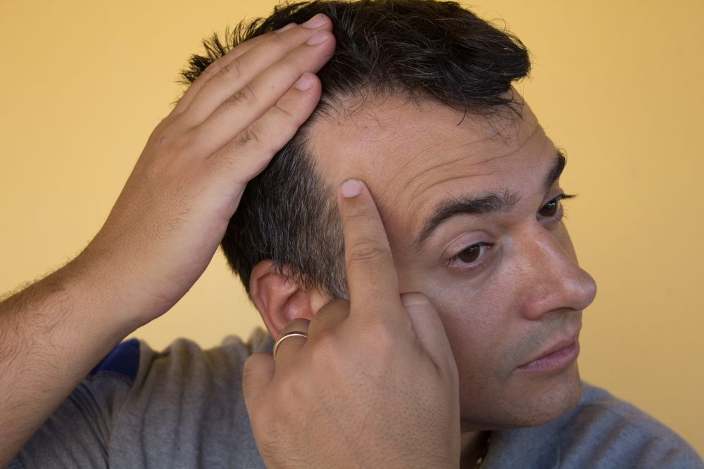 Man with a receding hairline pointing to the area of recession