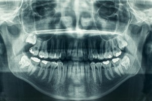 Xray of an overbite