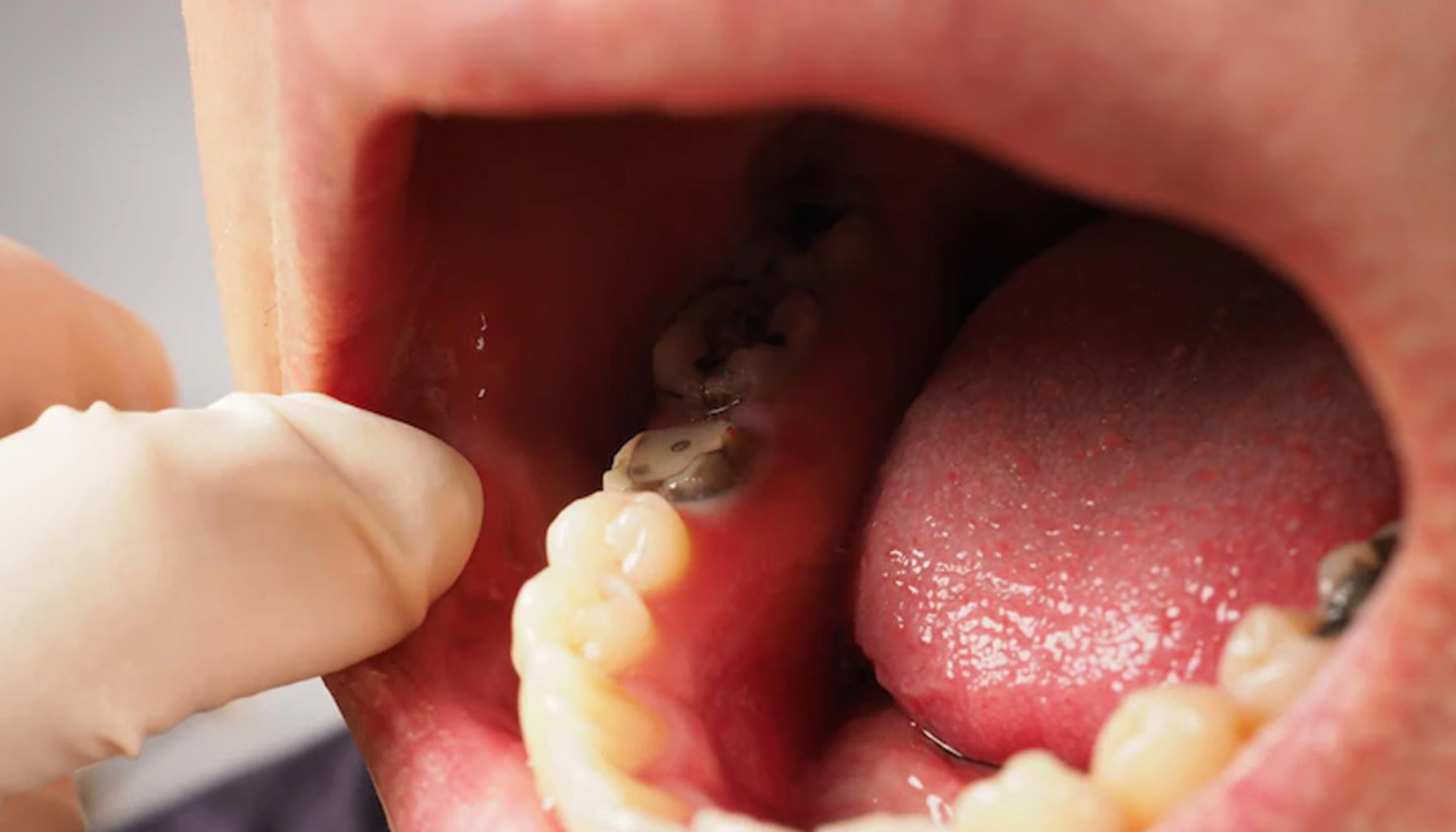 Nærbilde av åpen munn med tannfylling og synlige hull i jekslene, undersøkt med hanskekledd finger.