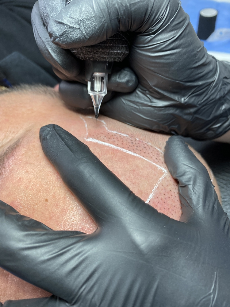 Man getting SMP treatment to his temple and hairline