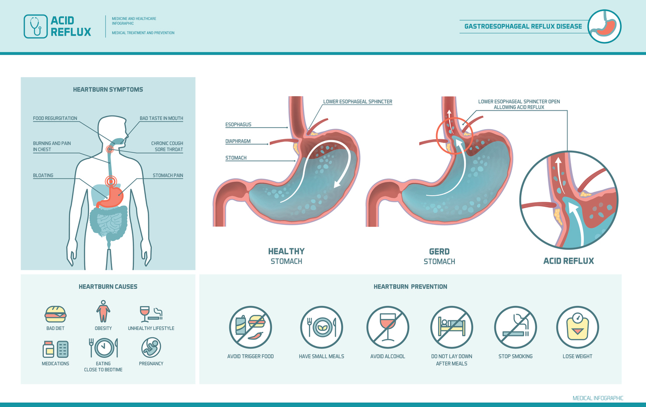 An acid reflux infographic with cartoon images showing symptoms and causes of acid reflux along with a healthy stomach, a GERD stomach, and an acid reflux stomach with labeling text described below. 