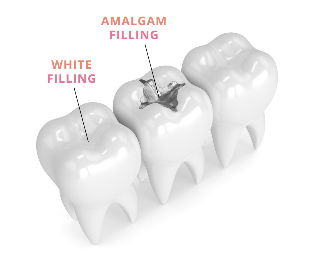 Composite Fillings Vs. Amalgam Fillings