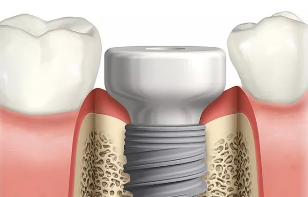 Image representing a healing abutment