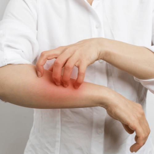 Managing Allergies