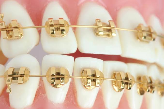 gold braces