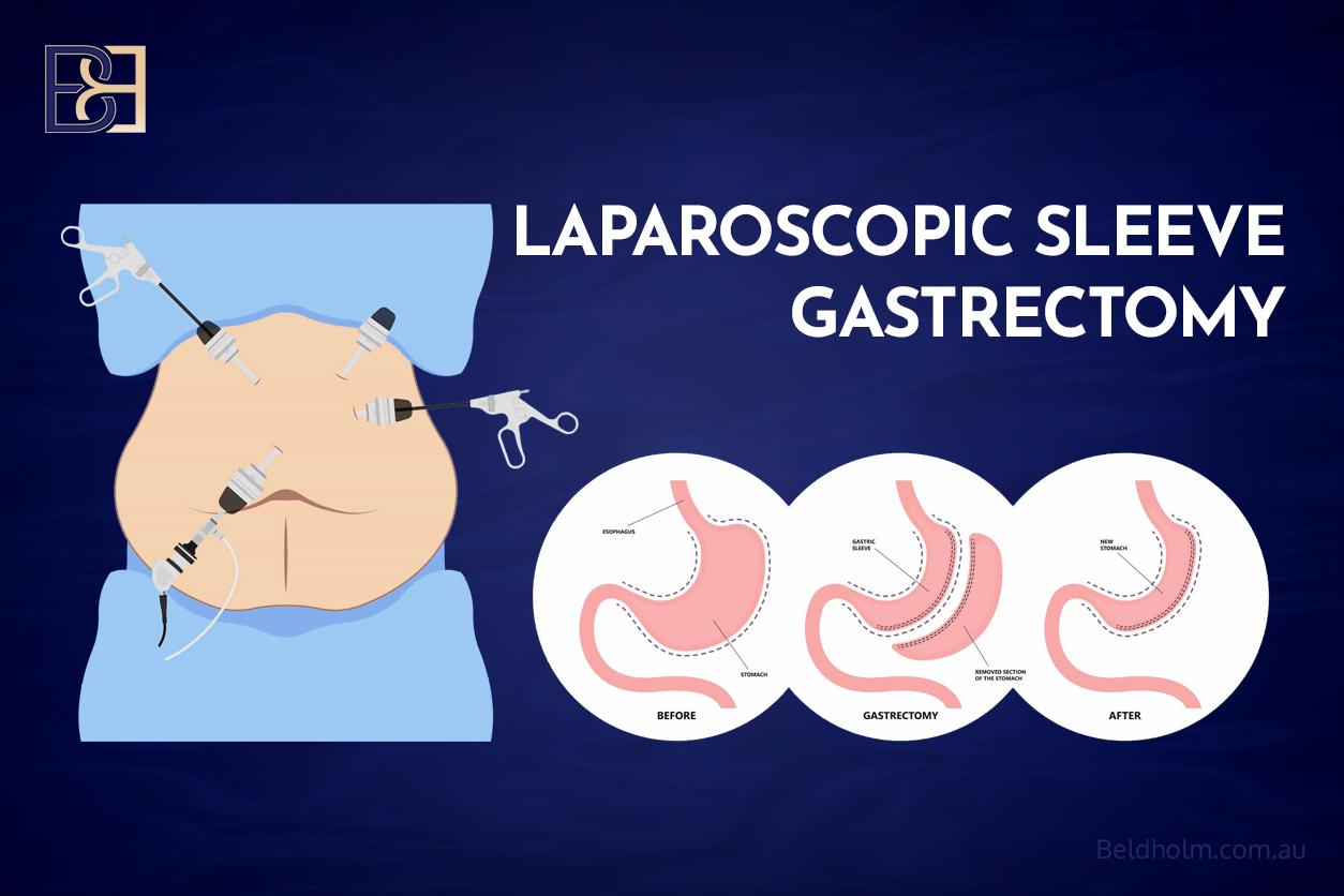 Vitamin A (Retinoid) Before and After Body Contouring Surgery: A Guide for Post Weight Loss Patients 11 Sleeve gastrectomy