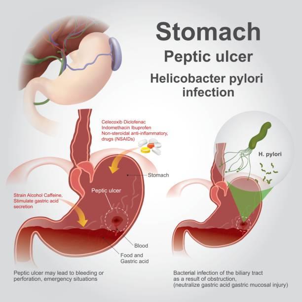 persistent ulcers | acid reflux | excess acid production | cancer helicobacter pylori | eventually lead | greater risk | all the difference | certain factors | other diseases | digestive health | worsen inflammation | balanced diet rich | pylori reduces | non hodgkin lymphoma | proper diagnosis | protective lining | ulcers cause cancer | common bacterium | making ulcers | reducing risk | prevention tips | small intestine | certain factotrs | limit long term | long lasting irritation | small tissue sample | alcohol intake | timely treatment
