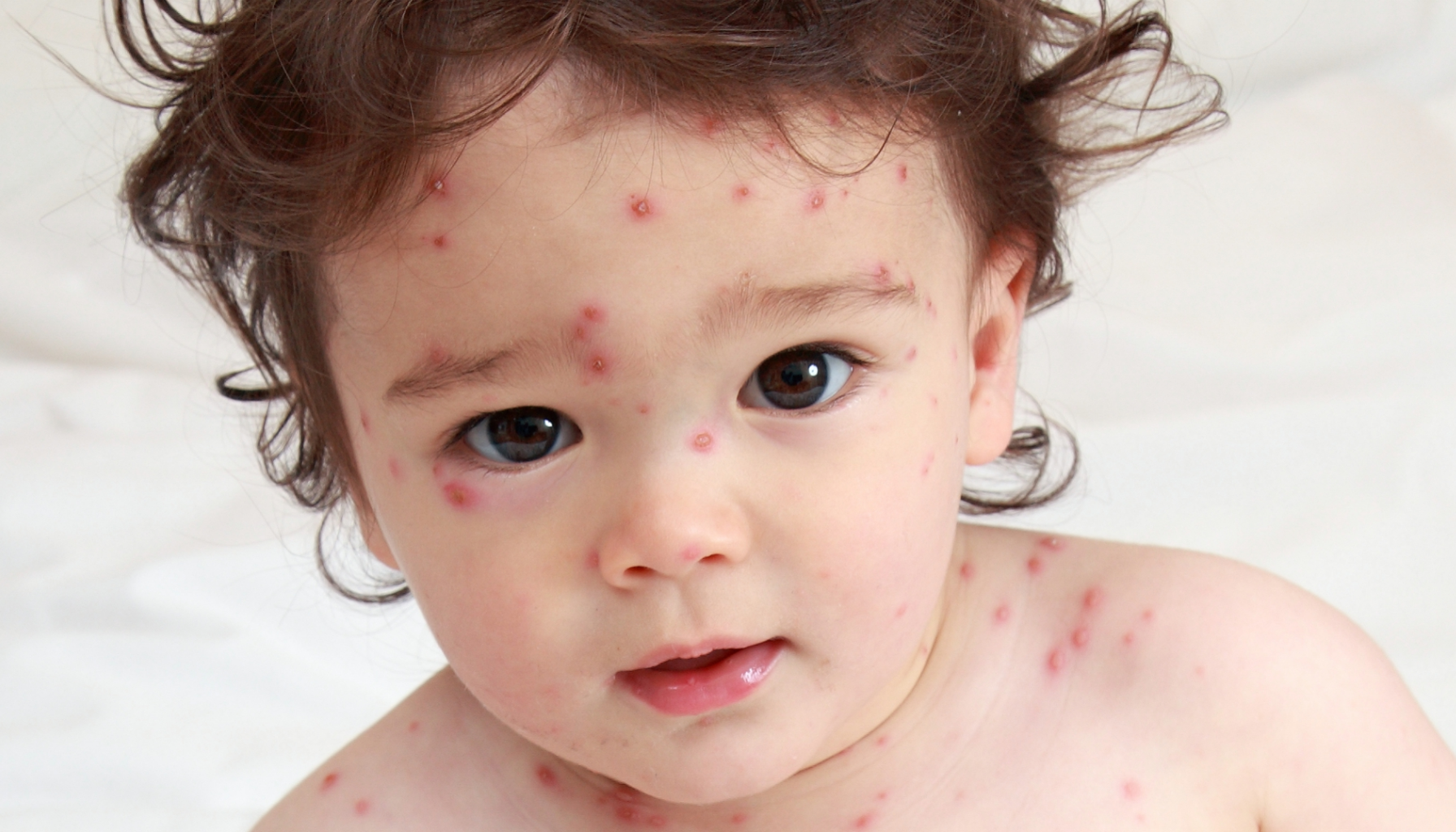 "Småbarn med vannkopper og røde utslett i ansiktet og på kroppen, ser rett mot kamera med mildt uttrykk. vannkopper herpes zoster hatt vannkopper vannkopper og herpes zoster varicella zoster virus varicella zoster personer med nedsatt immunforsvar nedsatt immunforsvar hos barn dager før utslettet 2 dager før utslettet får vannkopper varicella vannkopper senere i livet dager vanligvis 14 16 vanligvis 14 16 dager 21 dager vanligvis 14 antiviral behandling først og fremst barn under hos personer sykdom hos sjeldne tilfeller kontakt med personer alvorlig sykdom hos voksne alvorlig forløp svekket immunforsvar fleste barn vannkopper hos mer alvorlig 1 2 dager varicella økt risiko unngå kontakt normalt immunforsvar 5 dager lett feber barn of varicella hos eldre hos bør behandling personer 7 dager sykdommen smitte utslett får utslettet voksne innen 72 feber smittet lege symptomer pasienter alvorlig helvetesild andre sykdom gravide kontakt komplikasjoner immune innen viruset 1 2 risiko fleste første utbrudd tidligere dersom gis under infeksjon svært eksponering